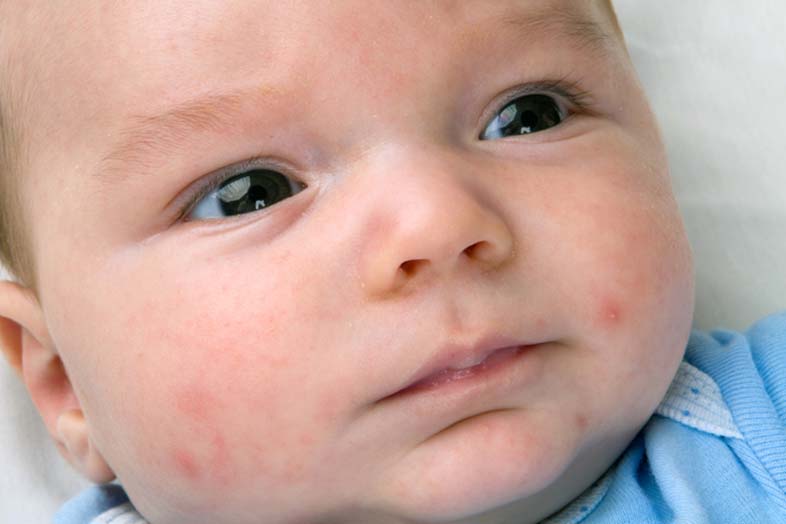 newborn baby with baby acne on the face.