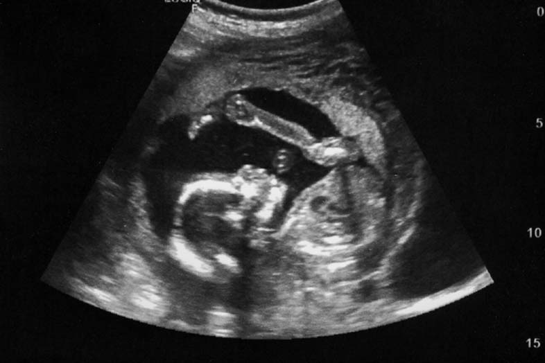 Your 12-week Scan: What to Expect | Huggies® UK