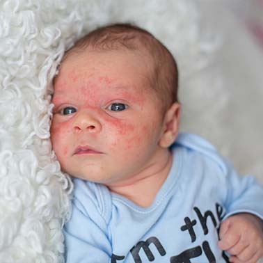 Newborn Baby Acne: How to Care & Treat at Home | Huggies® UK
